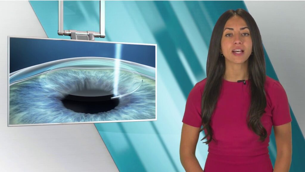 How Long Do Implantable Contact Lenses Last After Cataract Surgery?