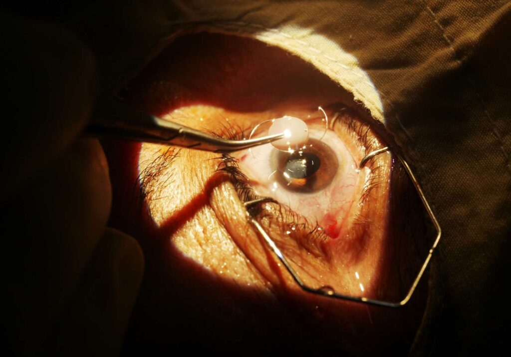 Cataracts Treatment